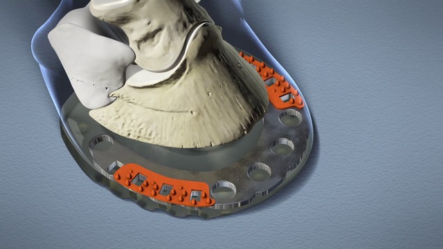 représentation de l'anatomie du sabot et, en dessous, le fer composite à nodules orange